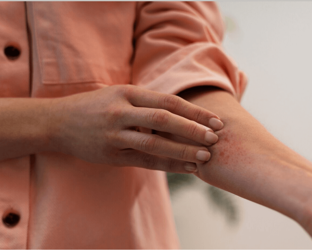 skin treatment for insect bites and stings