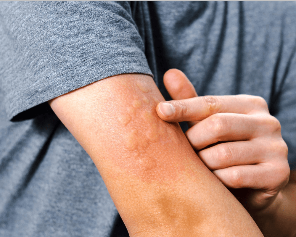 plant allergy rash treatment