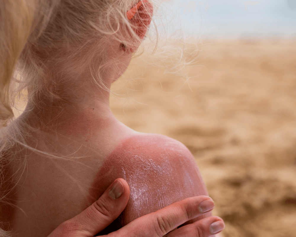 sunburn and chemical burn treatment
