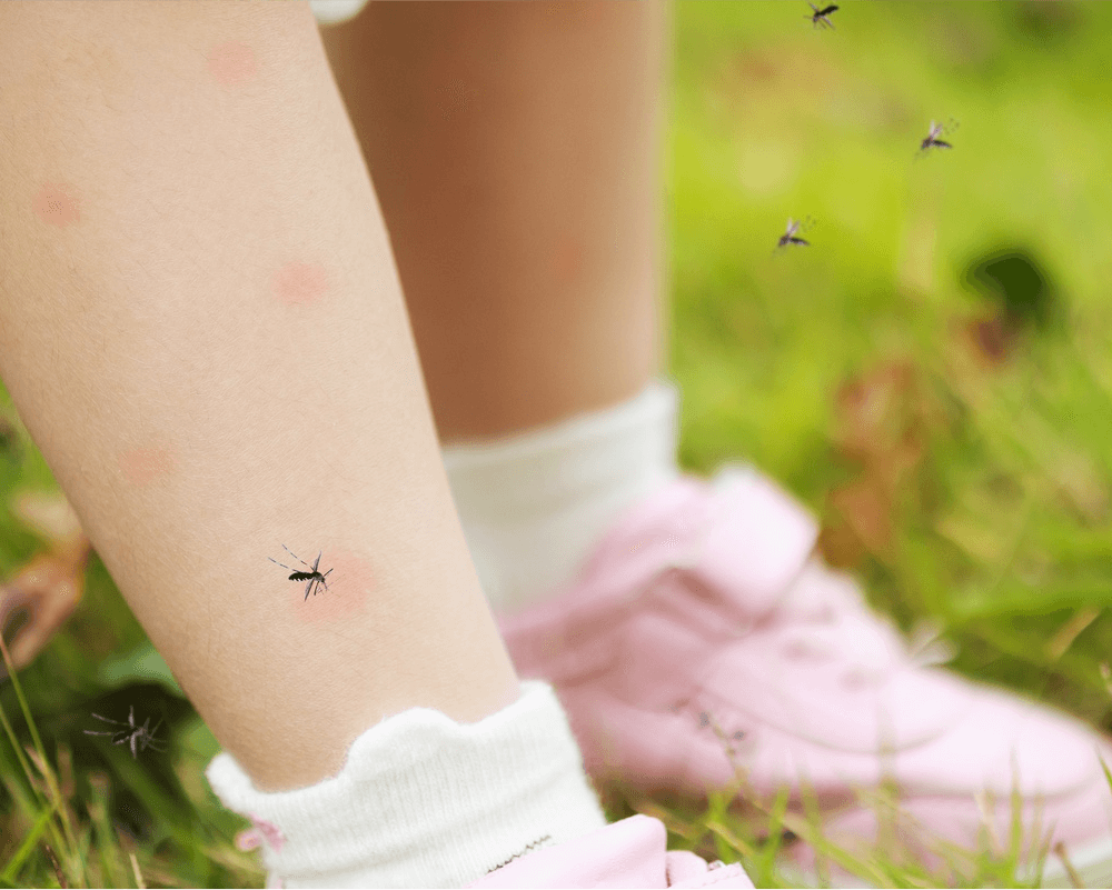skin treatment for insect bites
