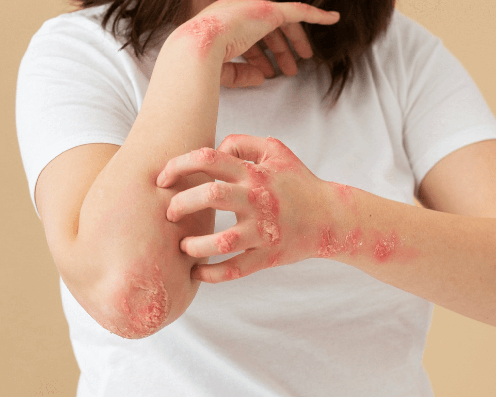 irritated skin rash