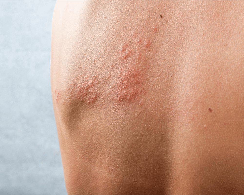 plant allergy rash treatment