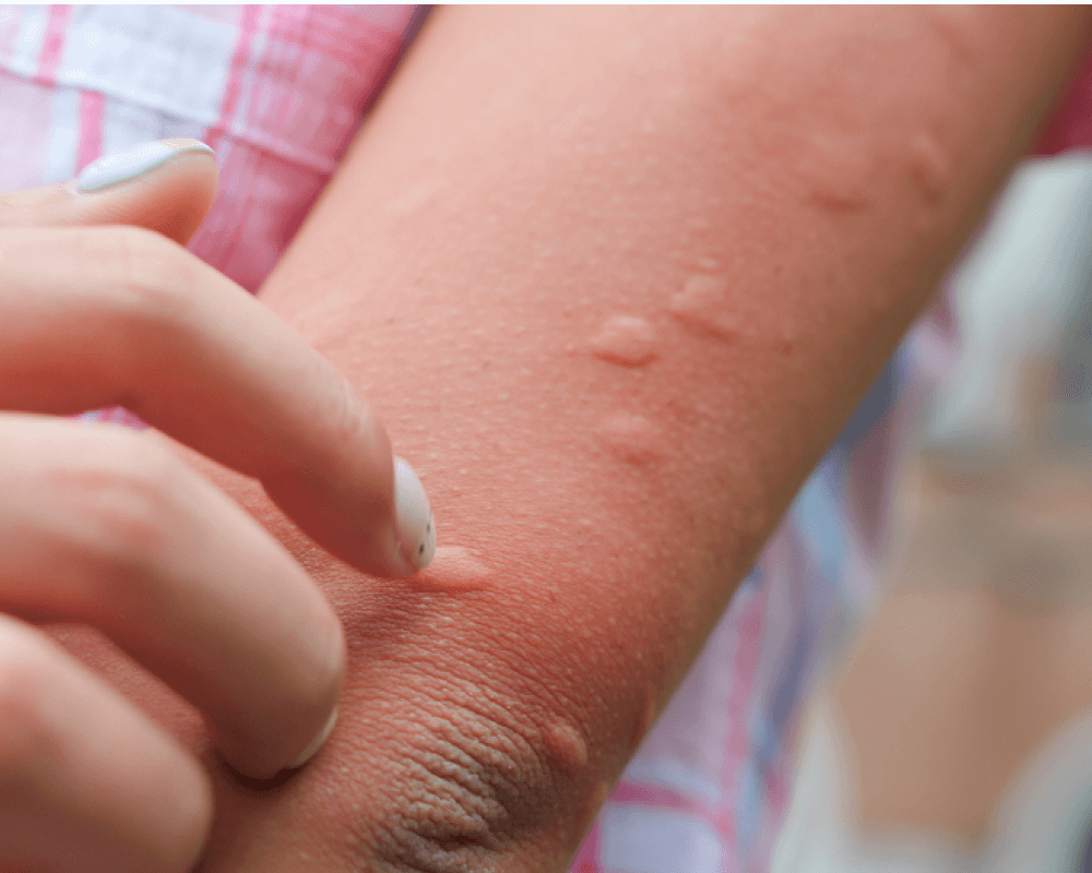 animal bite treatment