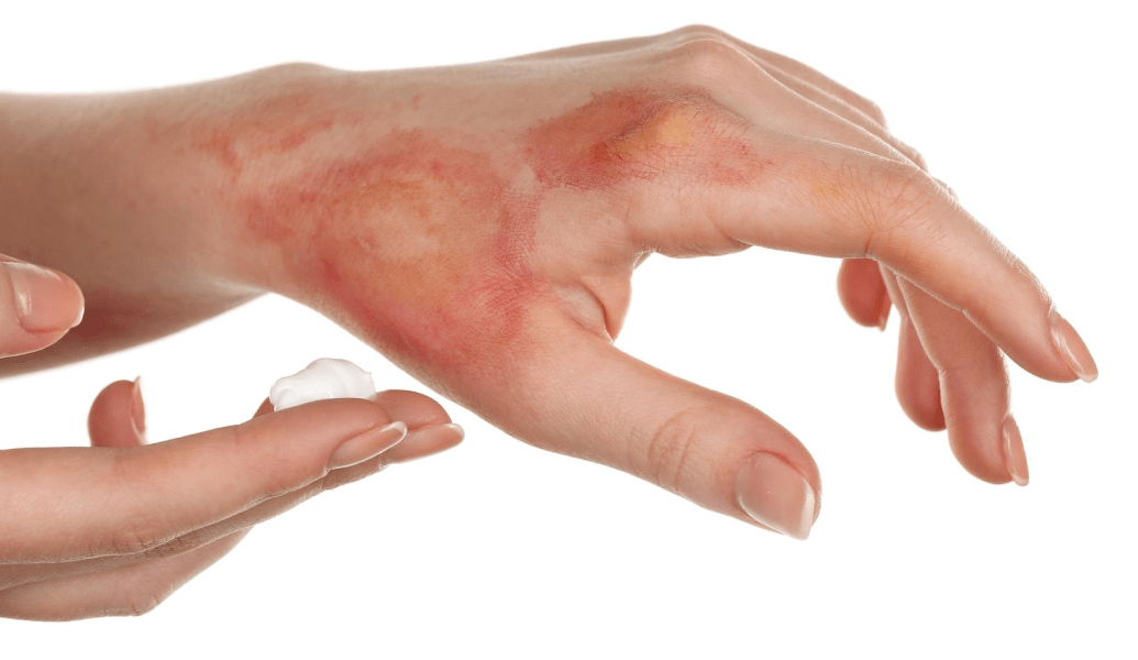 minor burns and rashes treatment