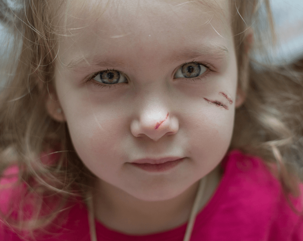skin laceration care