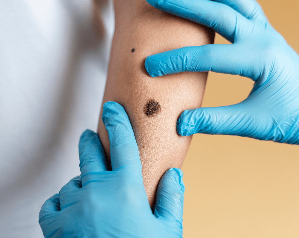 warts and fungal infection treatment